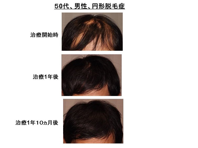 円形脱毛症　病院""